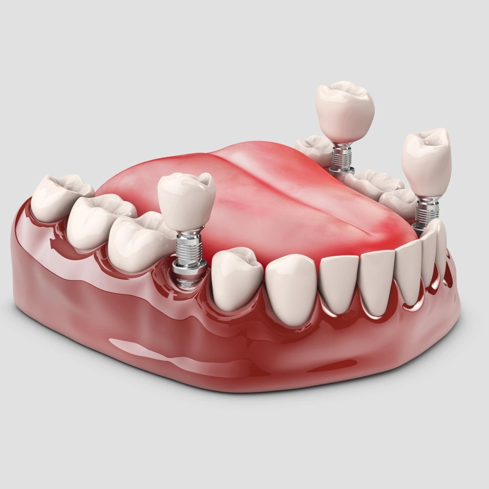 Implantodontia - Soluções personalizadas de Implante Dentário - Odonto Company Iguaba Grande